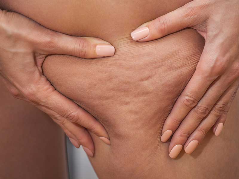 Anti-cellulite-MMBody Anti-cellulite-MMBody
